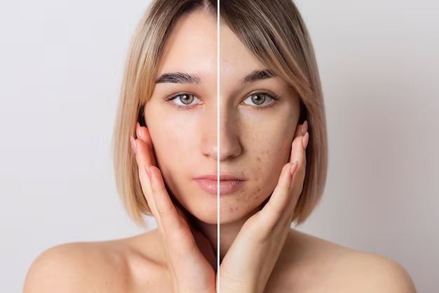 Understanding Hyperpigmentation : Causes and Treatment Options